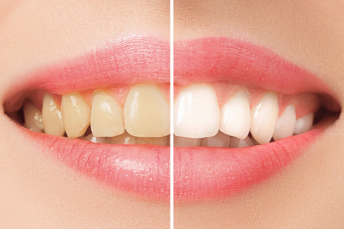 clinica_dental_llera_blanqueamiento_dental_1